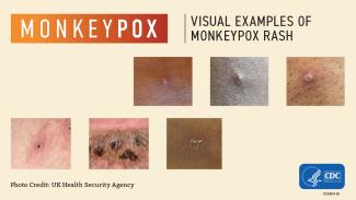 Monkeypox visuals